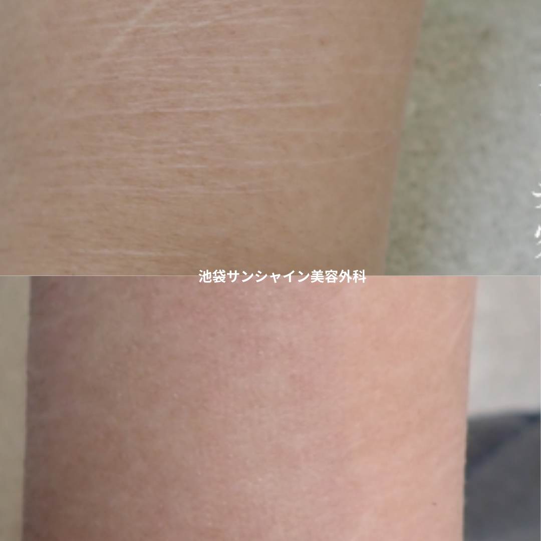 白い傷跡の治療7