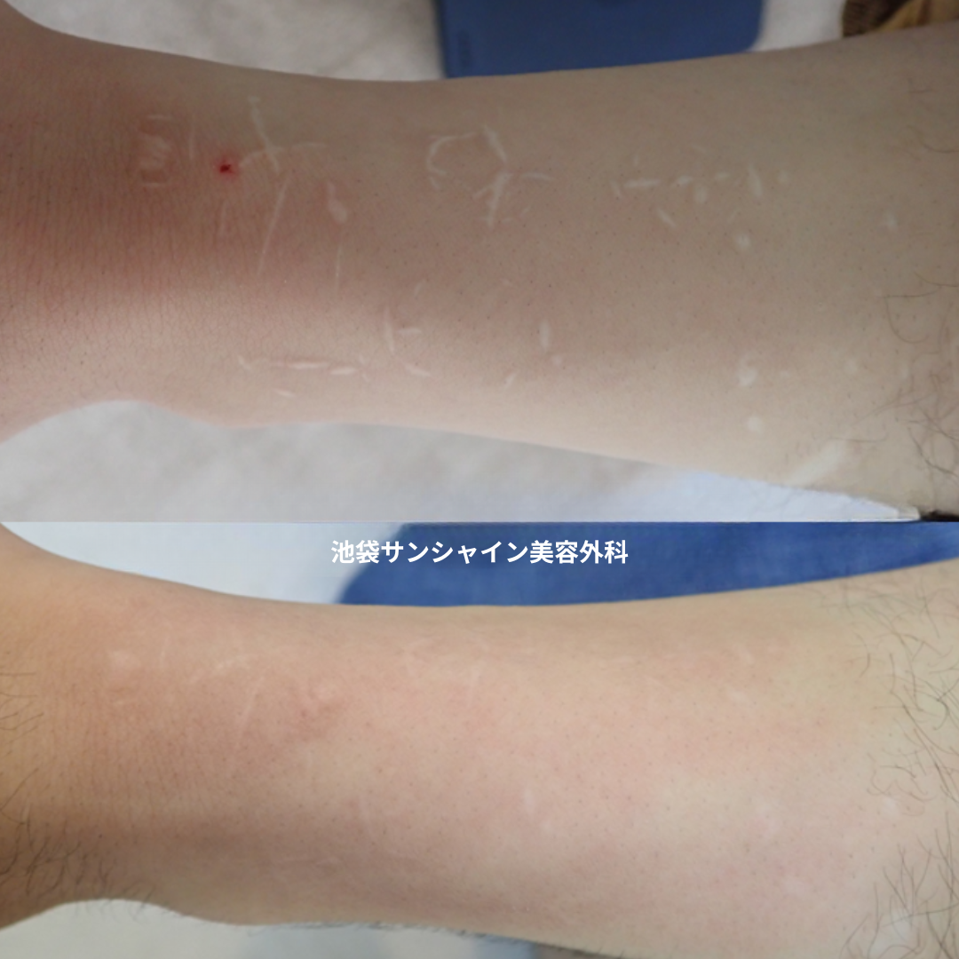 白い傷跡の治療8