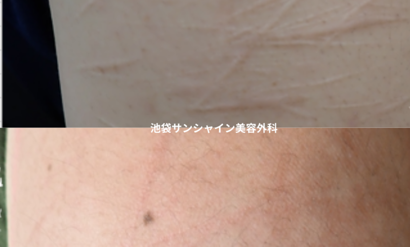 白い傷跡の治療9