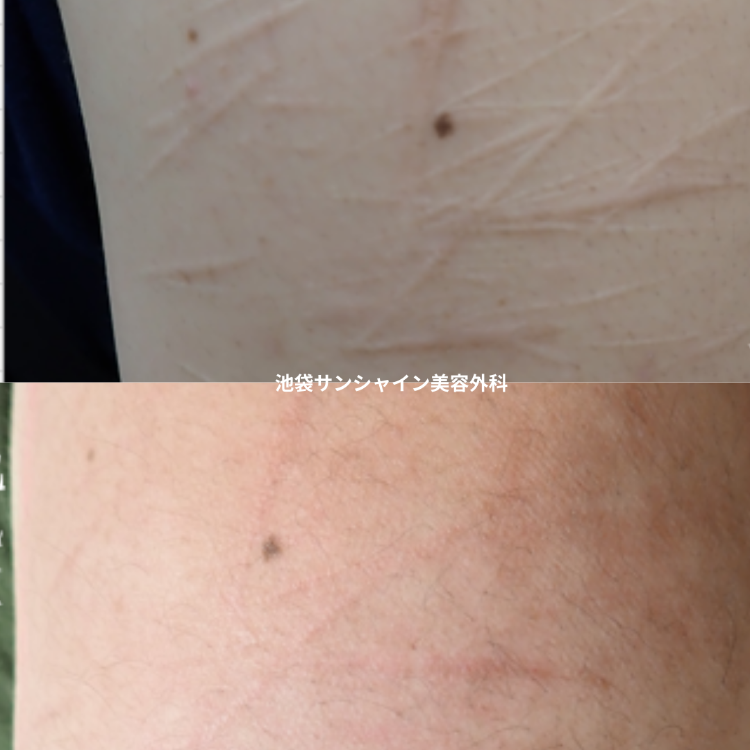 白い傷跡の治療9