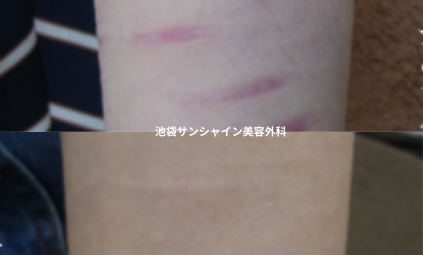 赤い傷跡の治療3