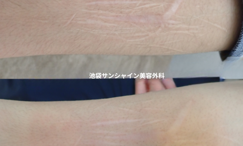 白い傷跡の治療10