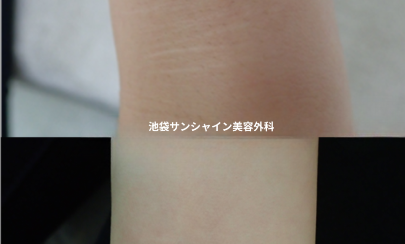白い傷跡の治療11