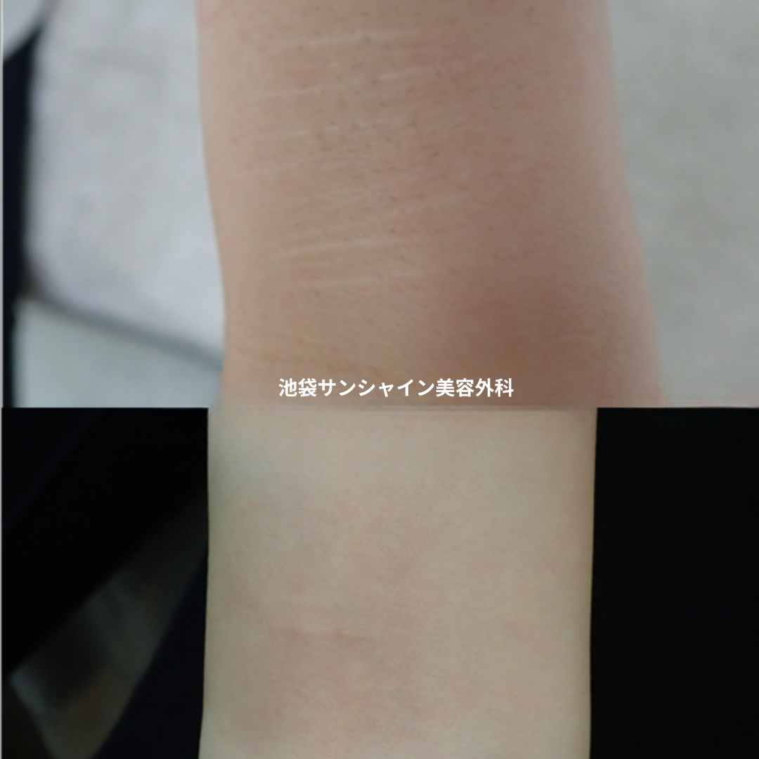 白い傷跡の治療11