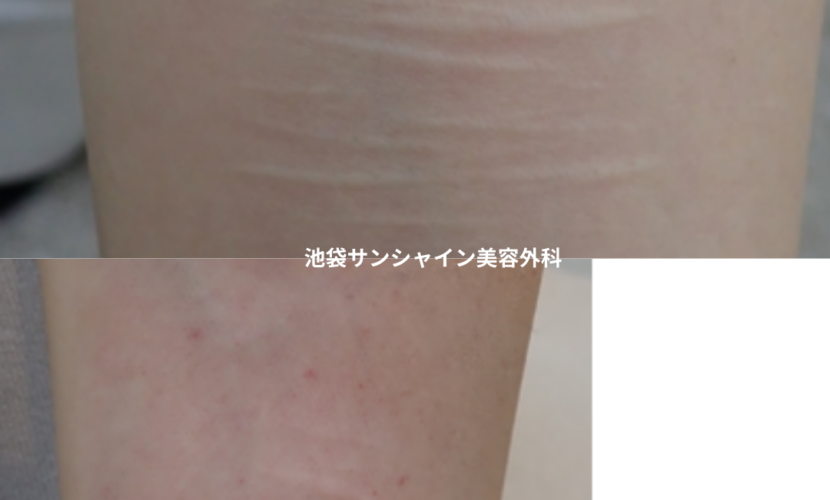 白い傷跡の治療12