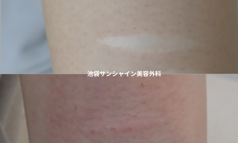 白い傷跡の治療13