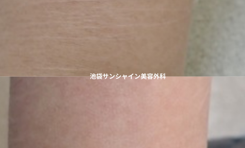 白い傷跡の治療14