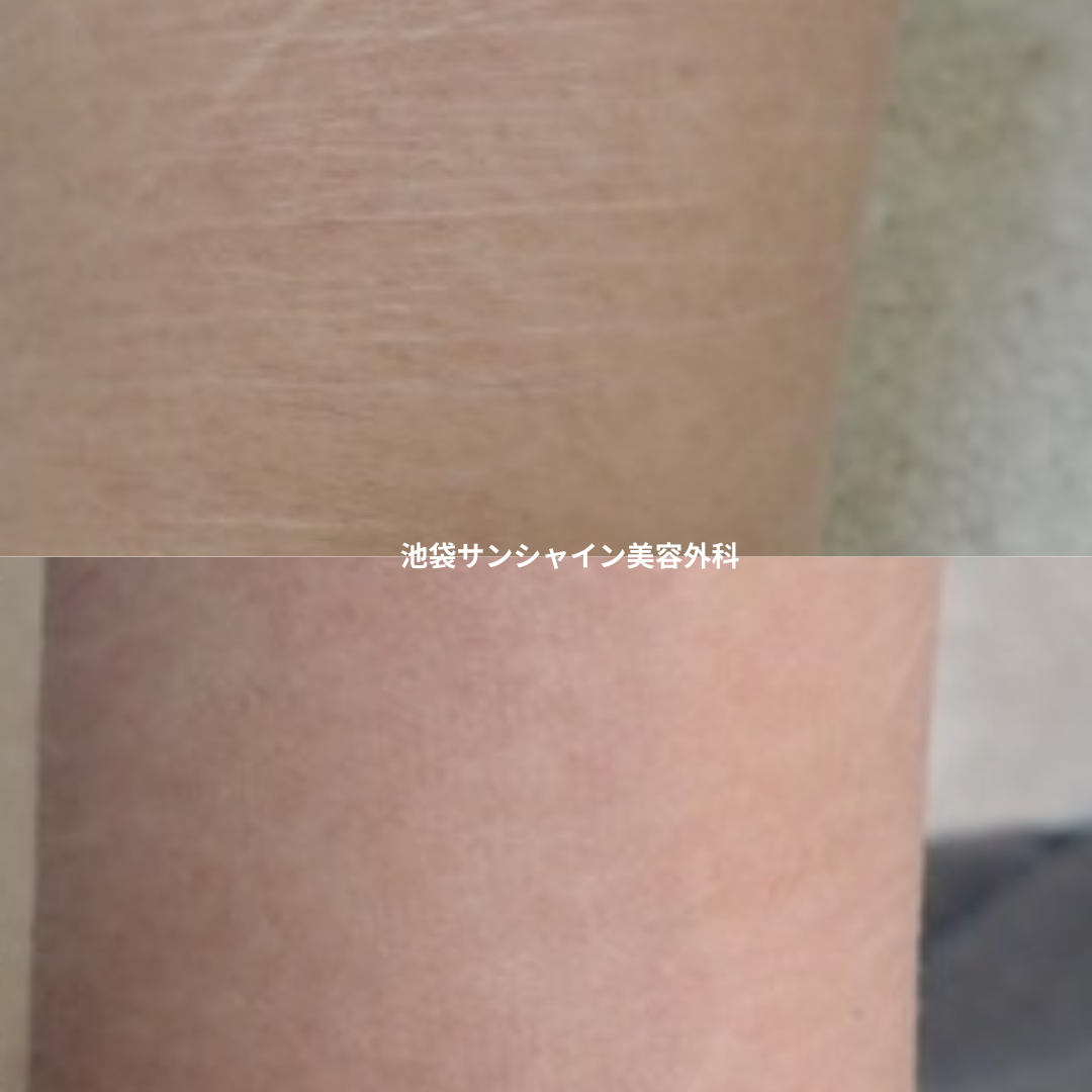 白い傷跡の治療14