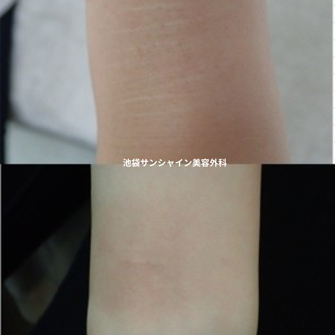 白い傷跡の治療16