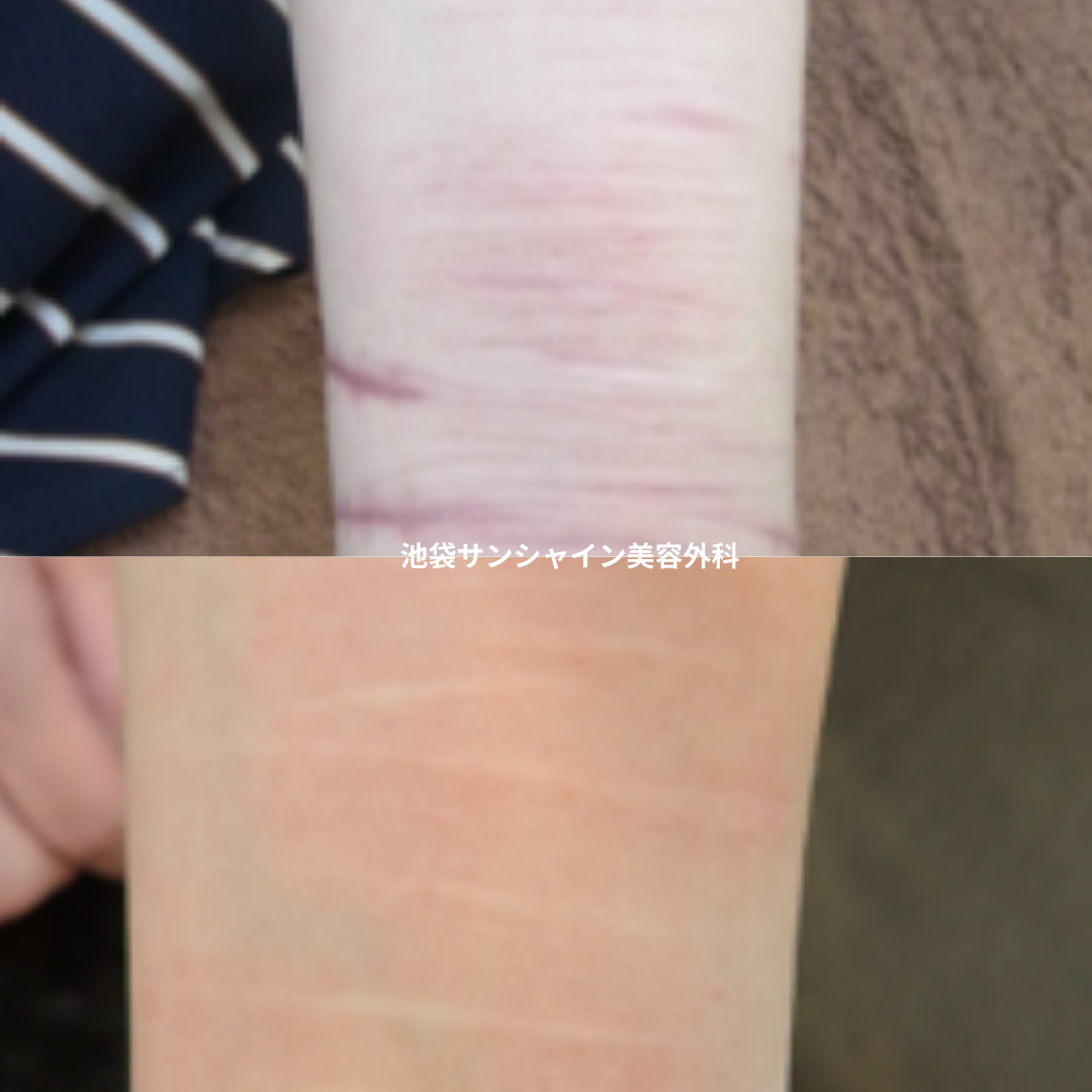 赤い傷跡の治療4