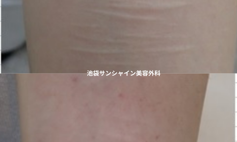 白い傷跡の治療17