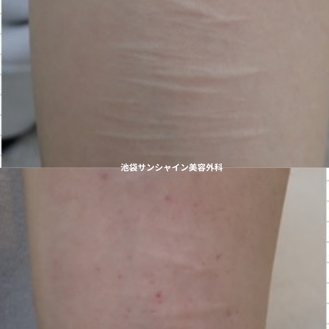 白い傷跡の治療17