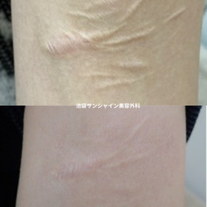 白い傷跡の治療18