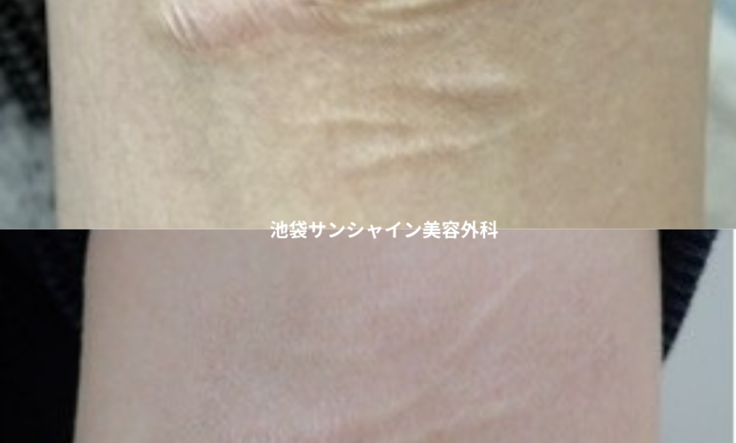 白い傷跡の治療18