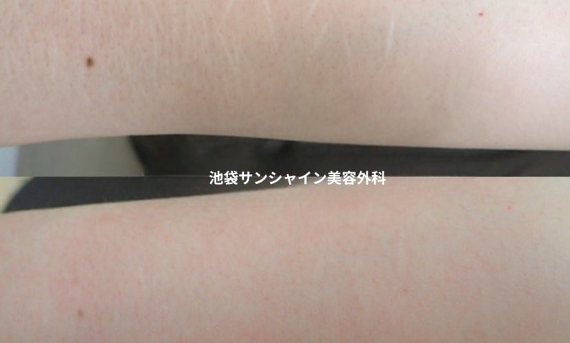 白い傷跡の治療19