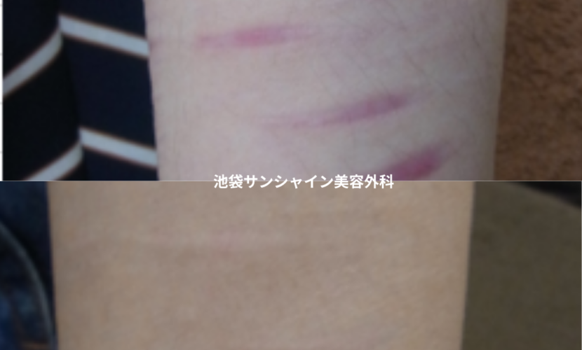 赤い傷跡の治療5