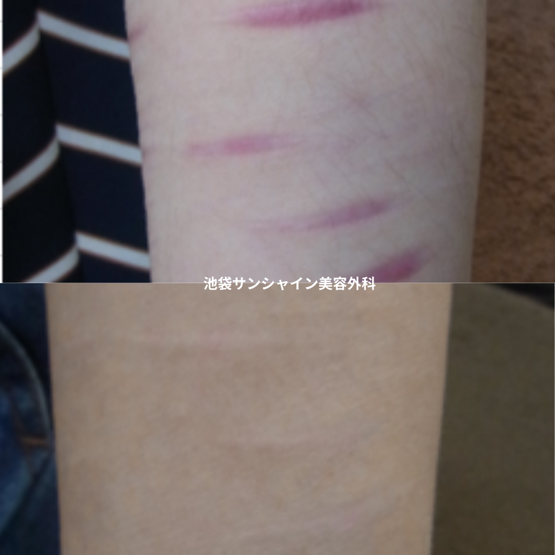 赤い傷跡の治療5