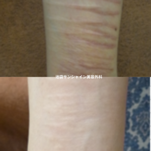 赤い傷跡の治療6