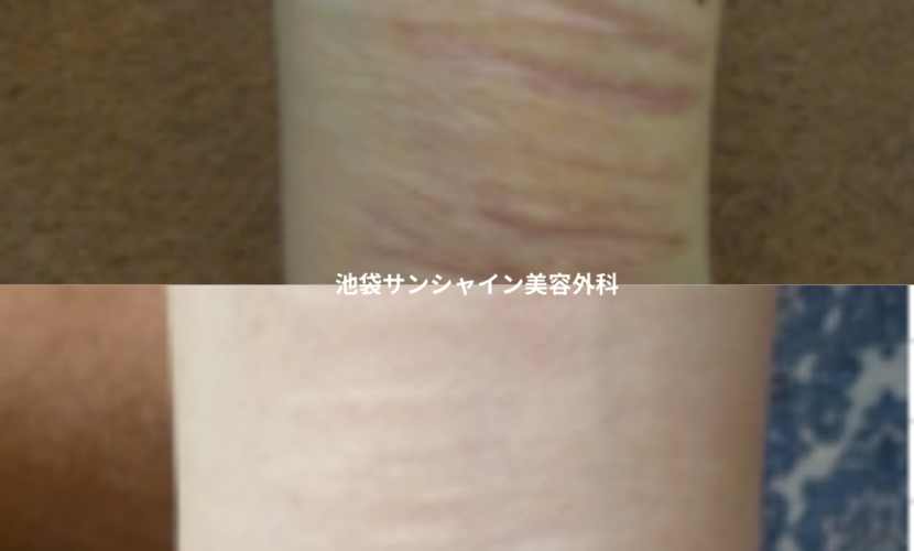 赤い傷跡の治療6