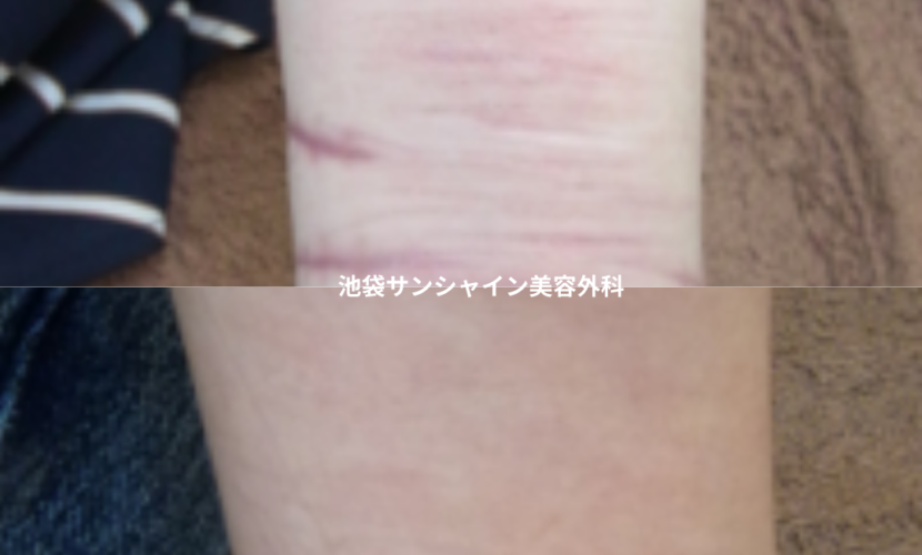 赤い傷跡の治療7