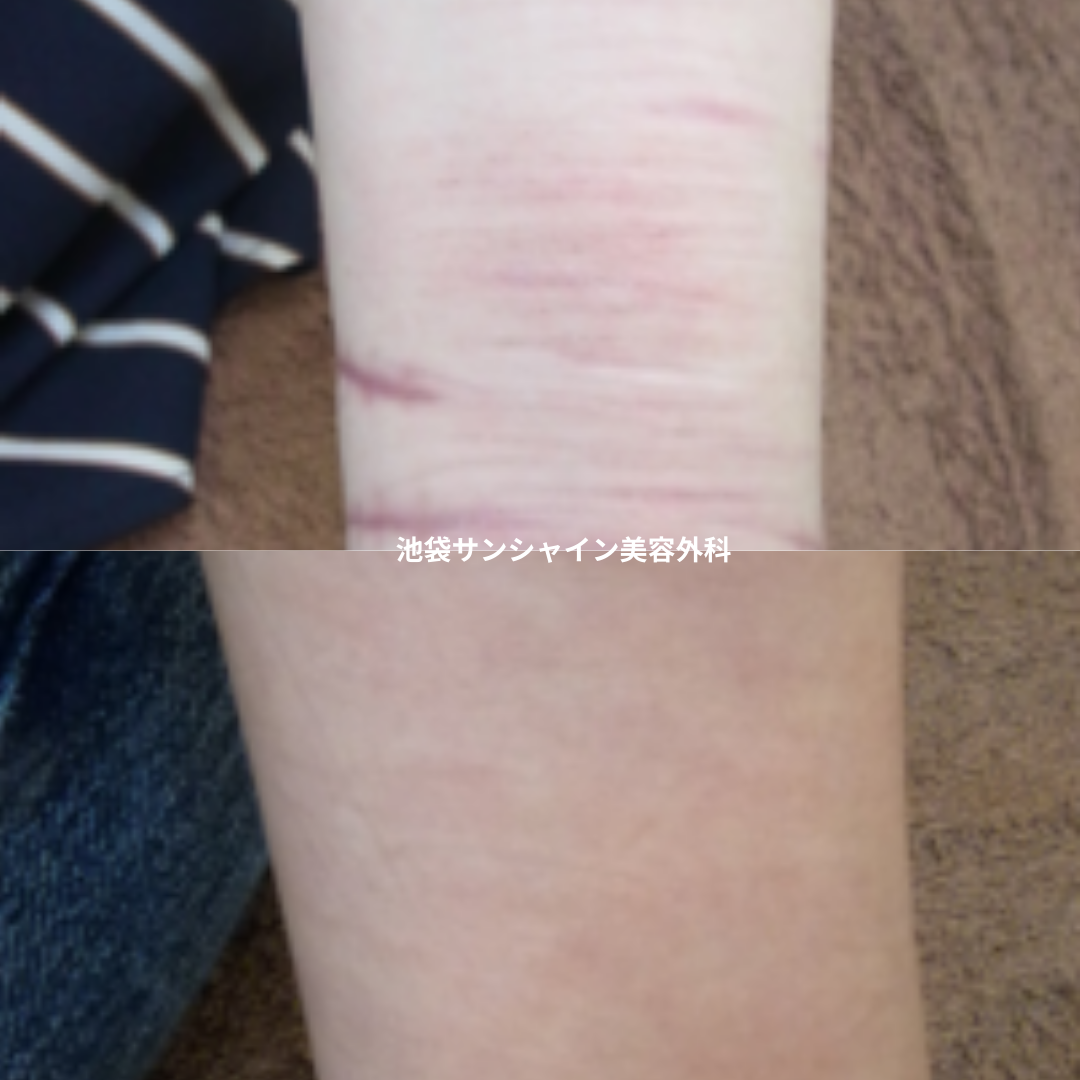 赤い傷跡の治療7