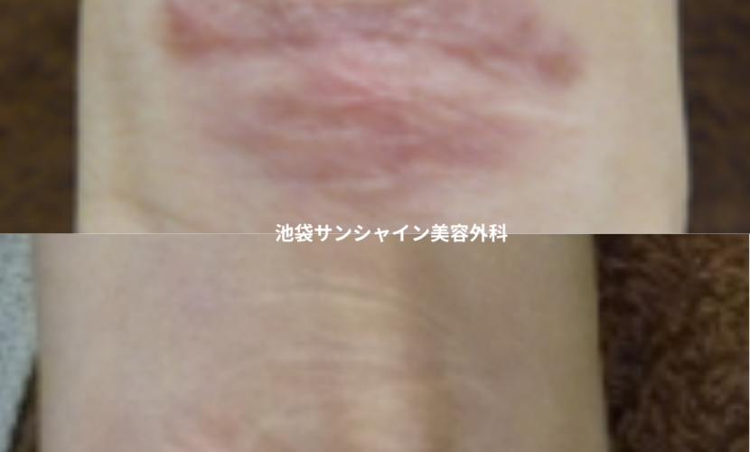 赤い傷跡の治療9