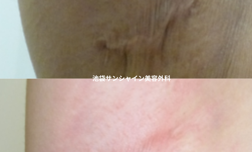 赤い傷跡の治療10