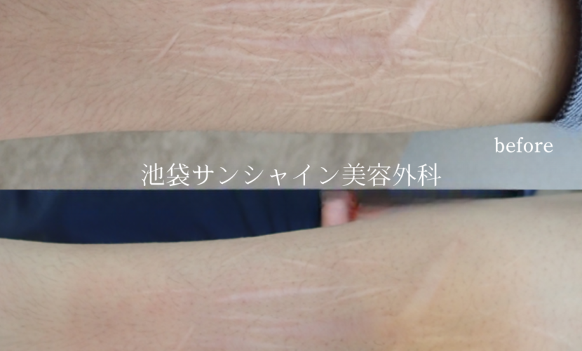 白く盛り上がった傷が多数ある症例