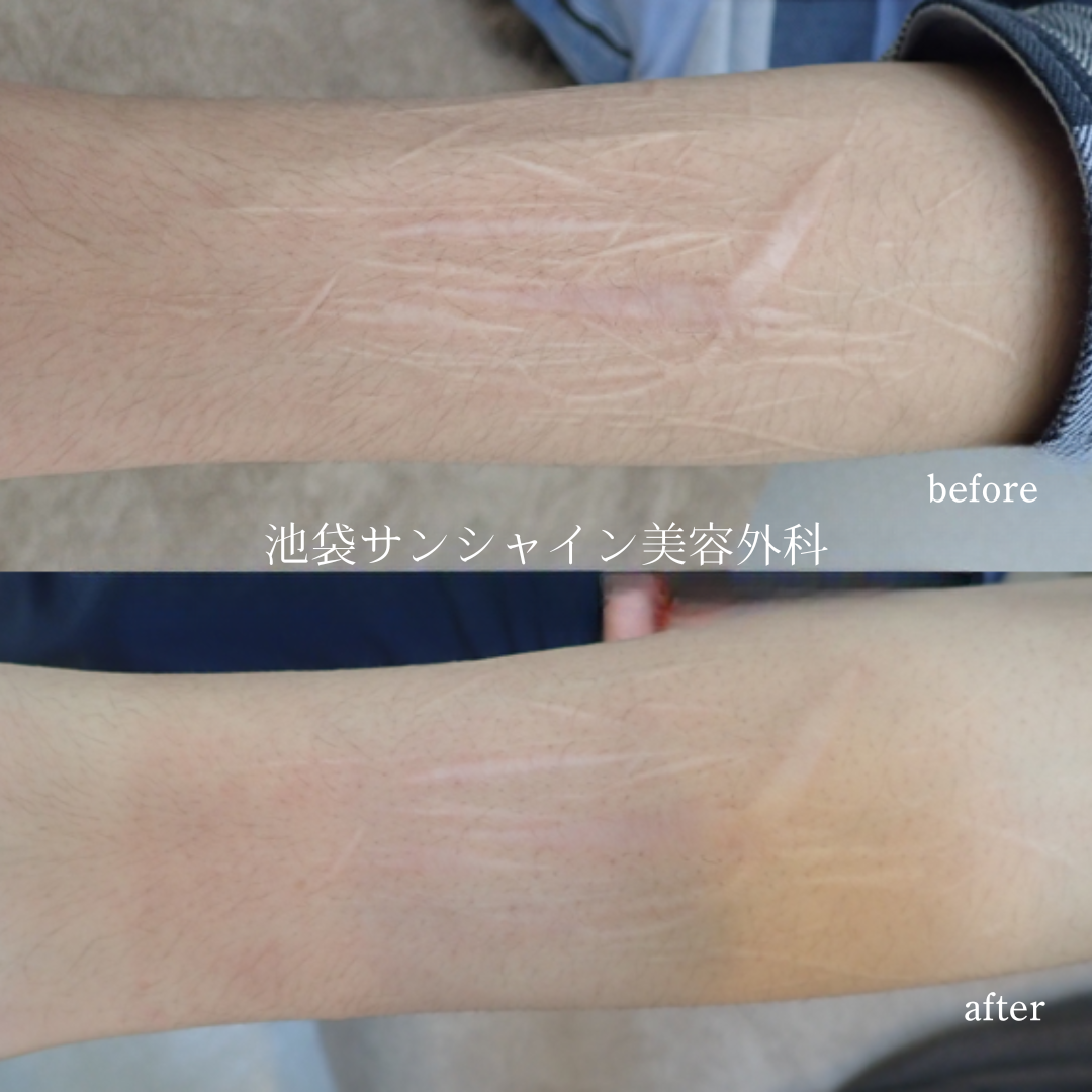 白く盛り上がった傷が多数ある症例