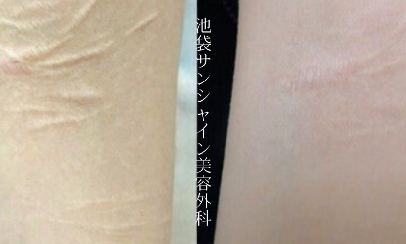 盛り上がった傷の治療症例済 1