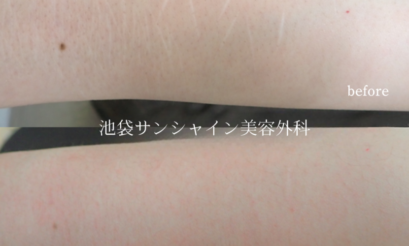 細かい白い傷がある症例