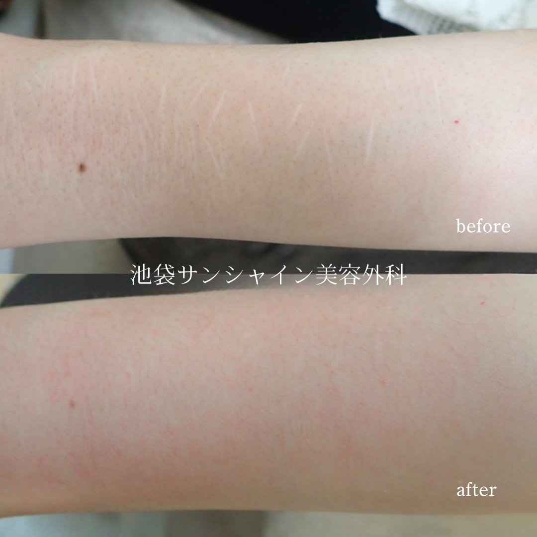 細かい白い傷がある症例