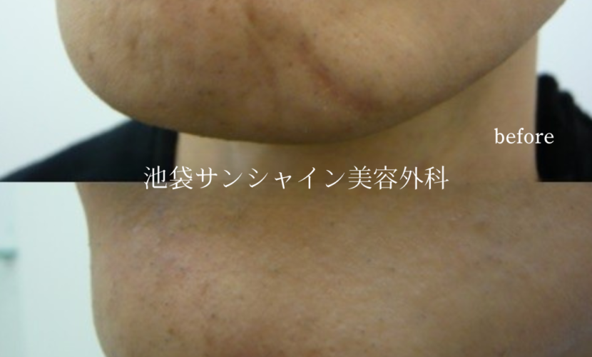 15年前のあごの傷跡