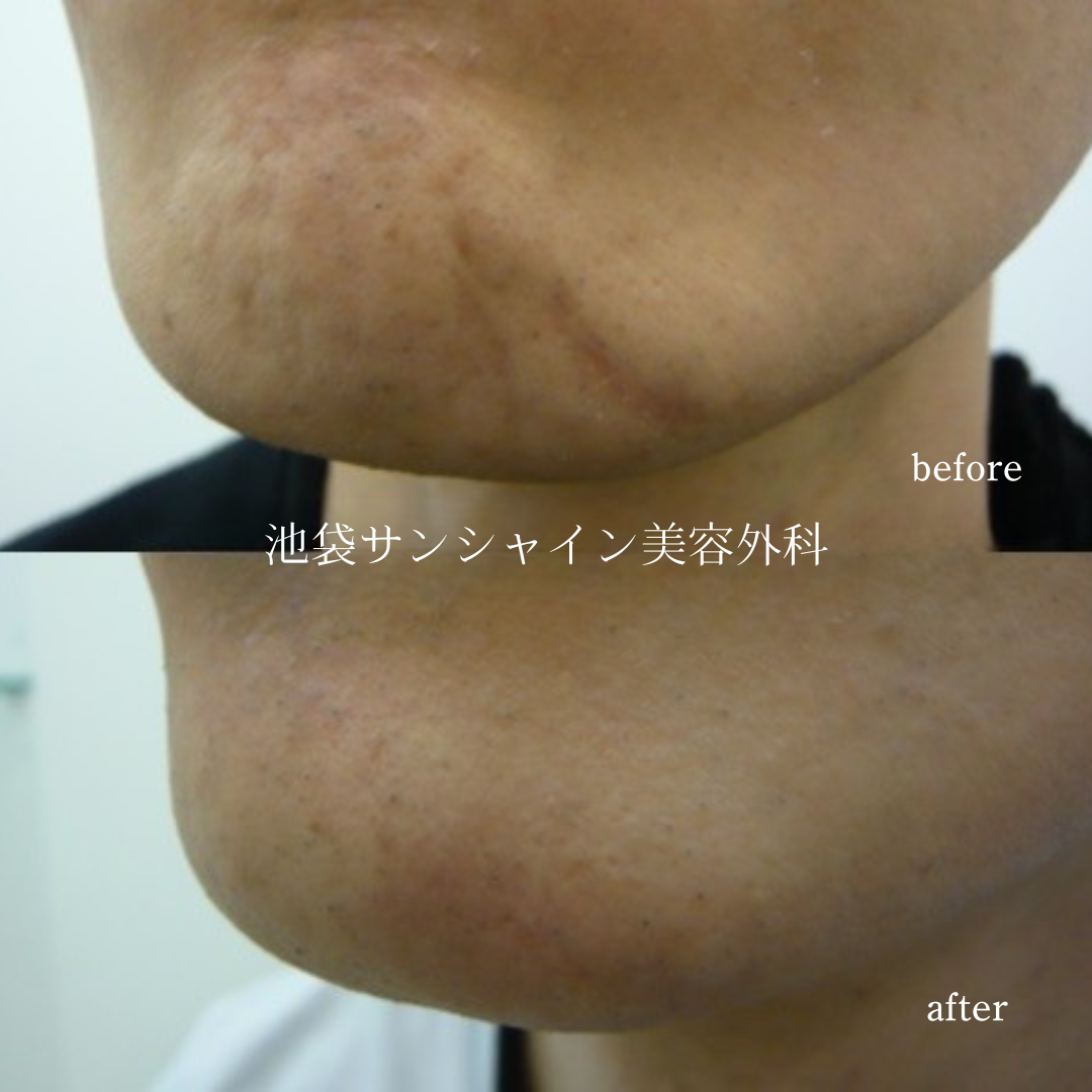 15年前のあごの傷跡