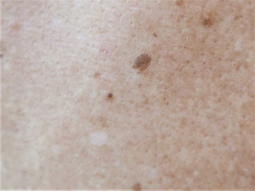 ほくろ除去を保険適用で受けられる条件