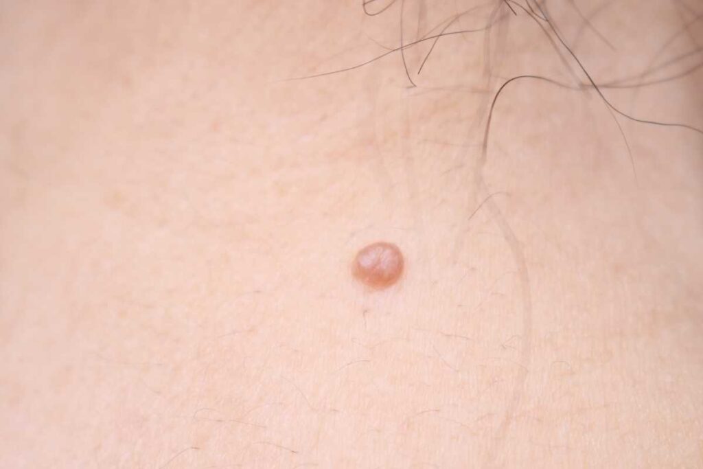 ほくろ除去の保険適用と自由診療の費用を比較