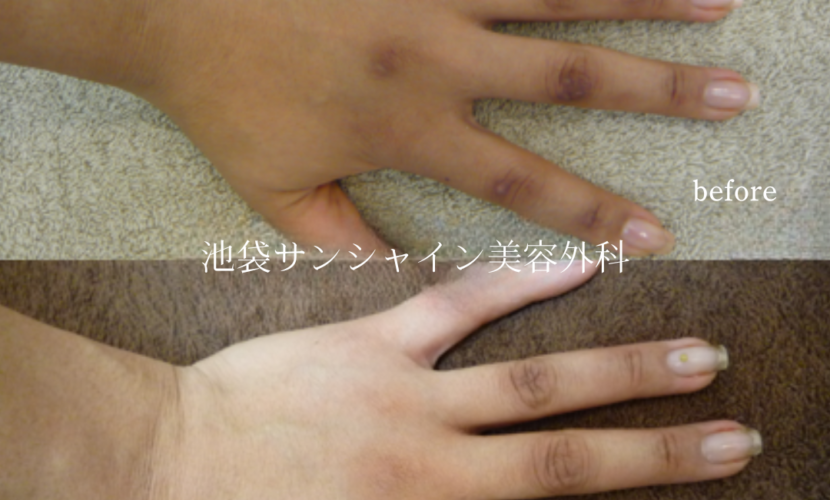 交通事故転倒の傷跡