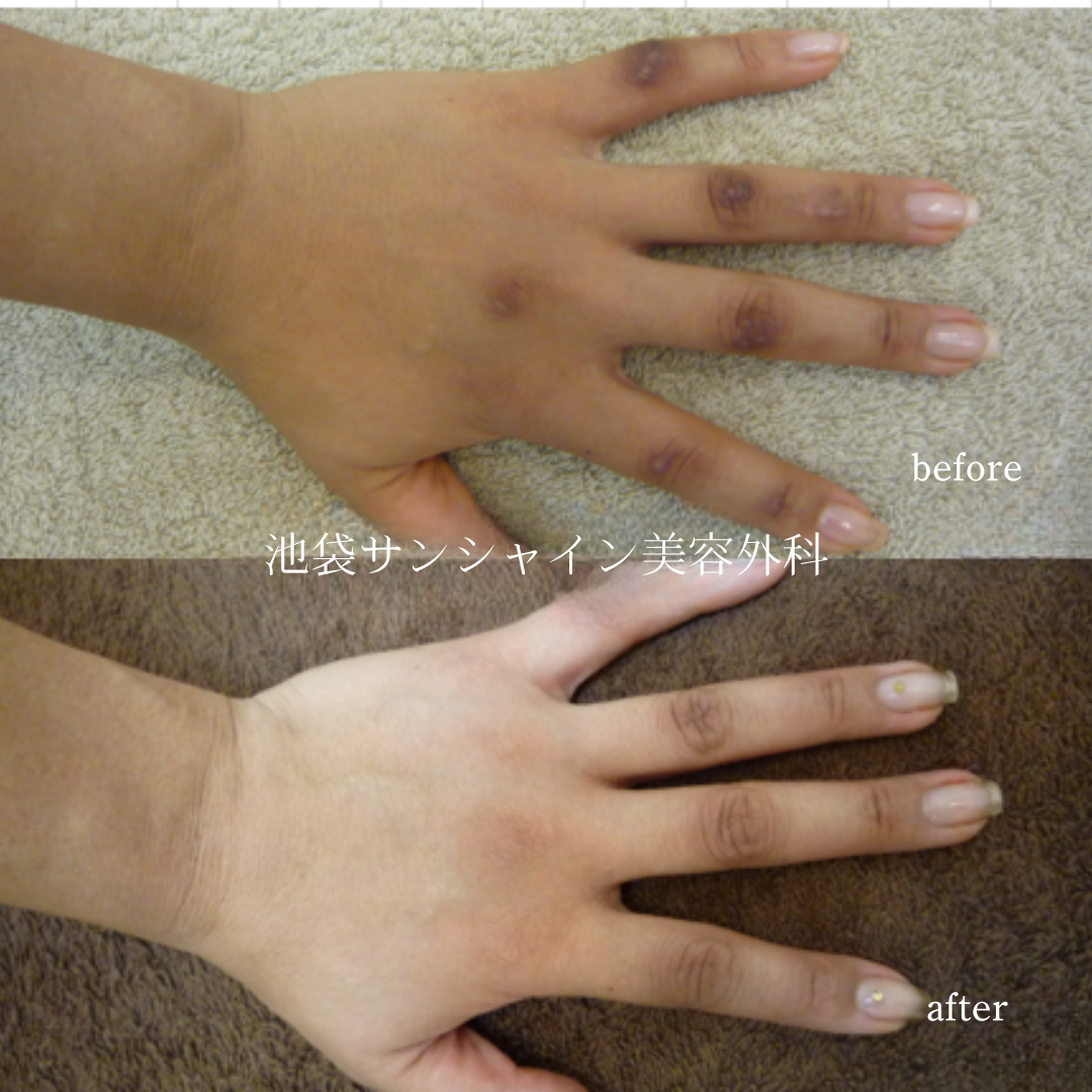 交通事故転倒の傷跡