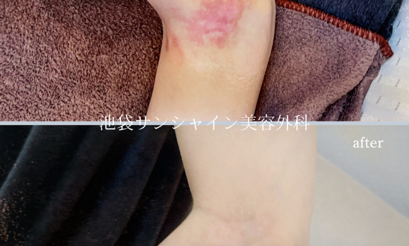 左肘の交通事故の傷