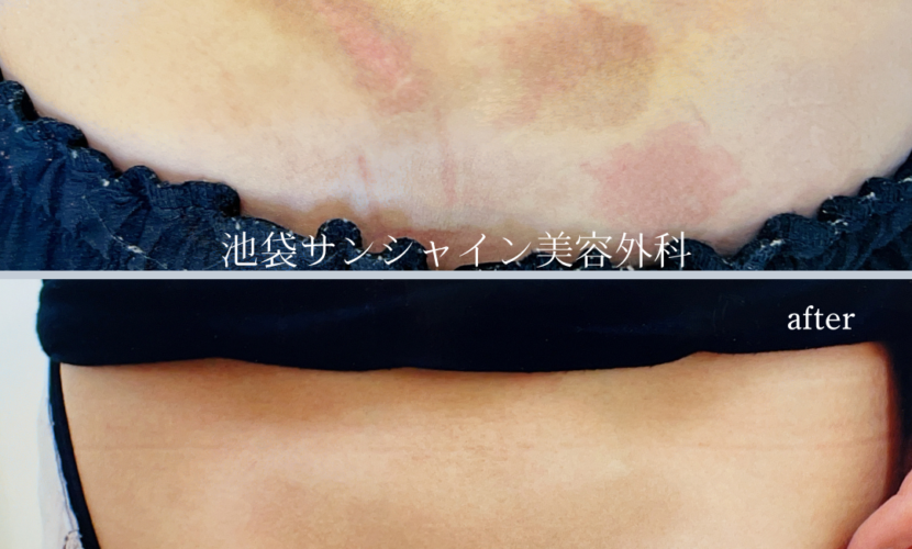 腰の交通事故の傷跡治療before after