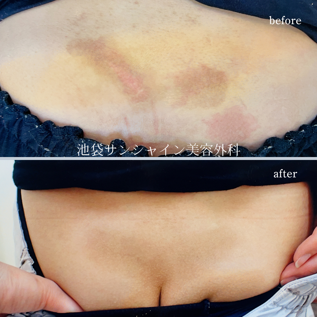 腰の交通事故の傷跡治療before after