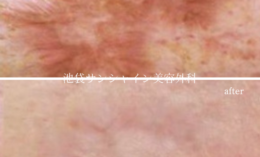 交通事故の傷跡