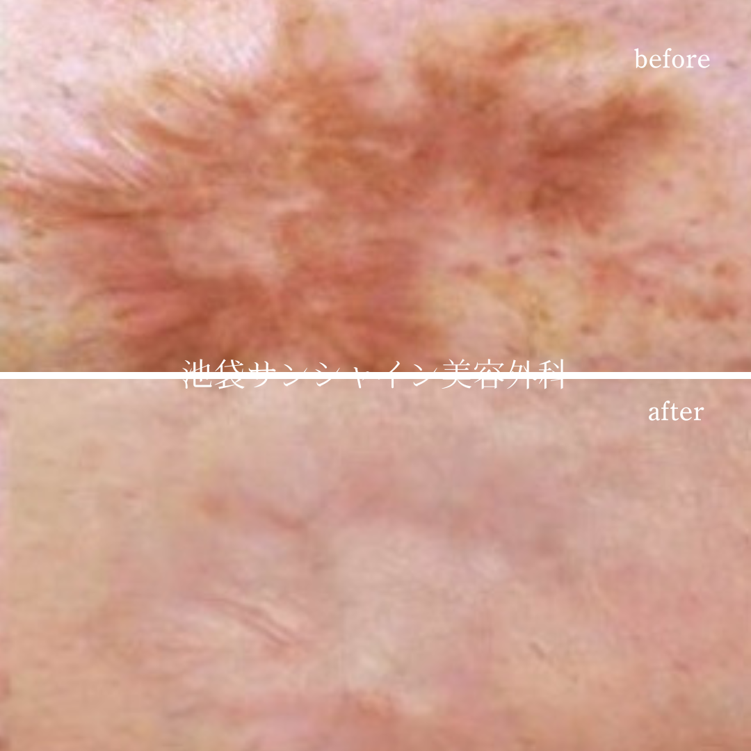 交通事故の傷跡