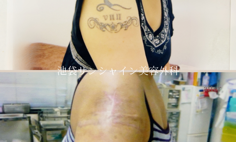 右上腕 のタトゥ除去 女性 before after