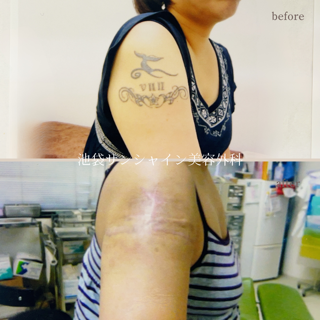 右上腕 のタトゥ除去 女性 before after