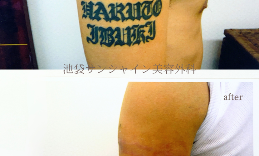 右上腕 アルファベット のタトゥ除去 before after