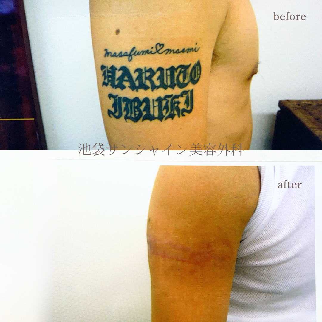右上腕 アルファベット のタトゥ除去 before after