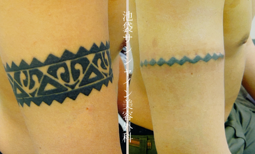 右腕男性のタトゥ除去 before after