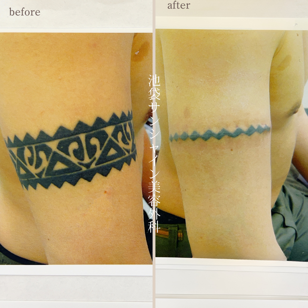 右腕男性のタトゥ除去 before after