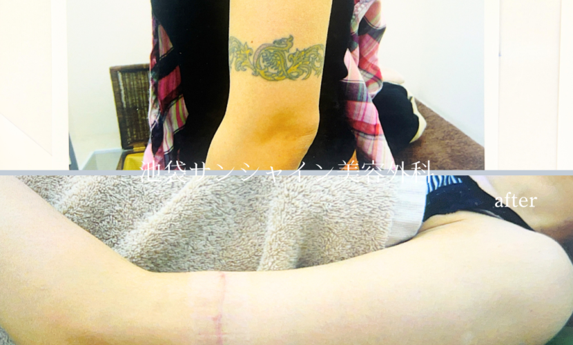 左ひじ上のタトゥ除去befoe after